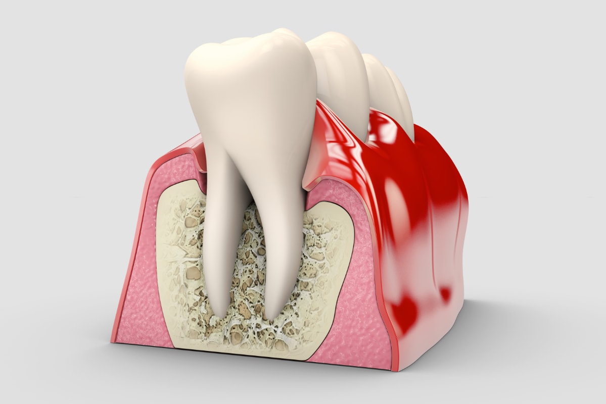 Que Es Periodoncia Dominguez Morales