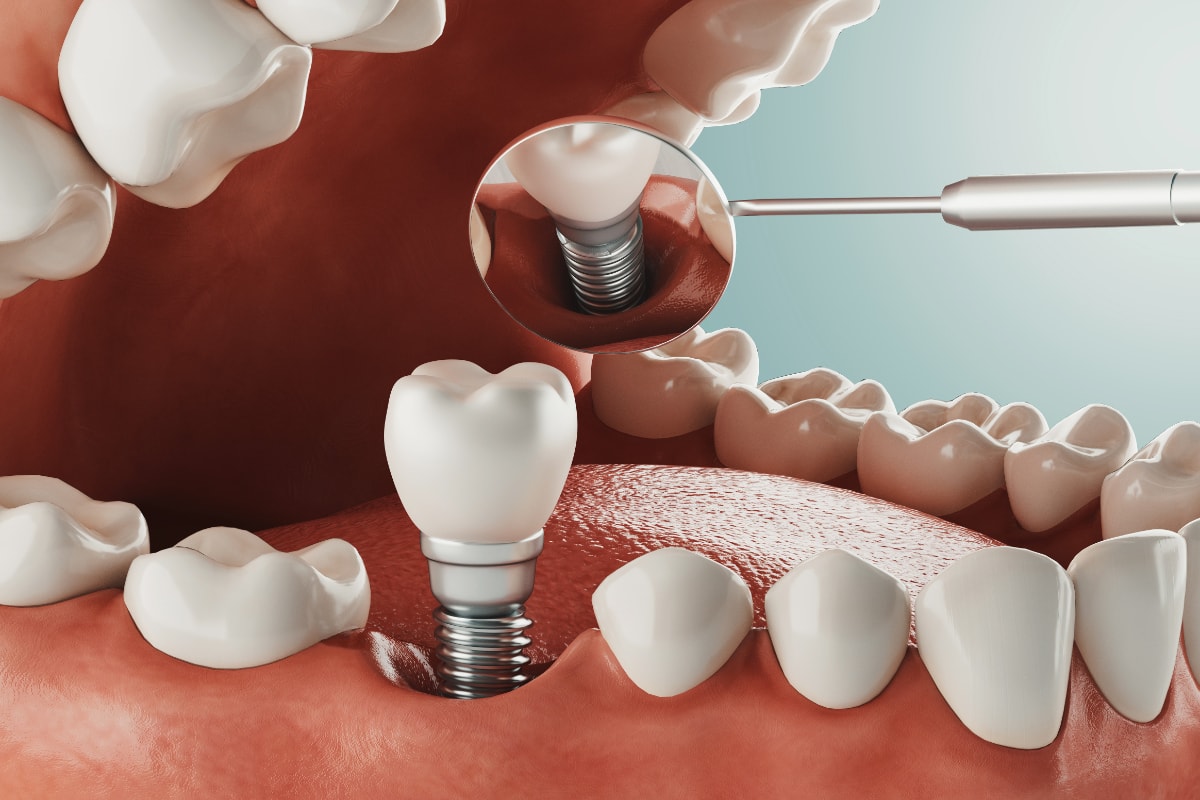 Visita Dentista Implantologia Dominguez Morales